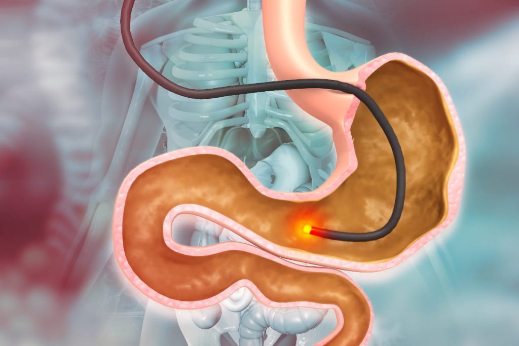 Human stomach with endoscope and close-up of Helicobacter pylori bacterium