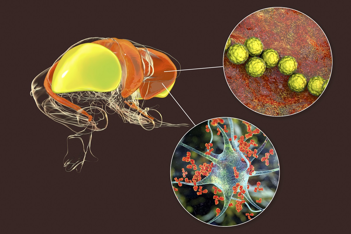 3D illustration of Pediatric Brain Infection