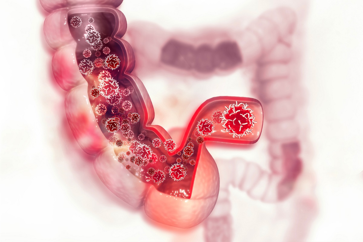 Acute Myeloid Colorectal Cancer Attacking Cells