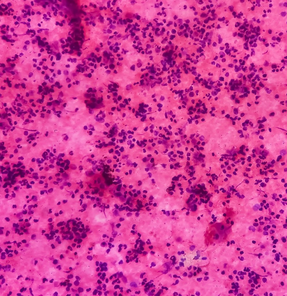 Microscopic View of Chronic Myeloid Leukemia Cells